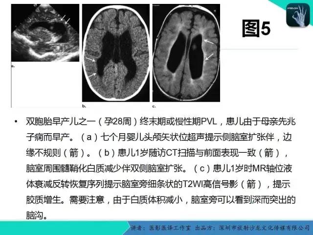 【PPT】新生儿缺氧缺血性脑病多模态影像学表现