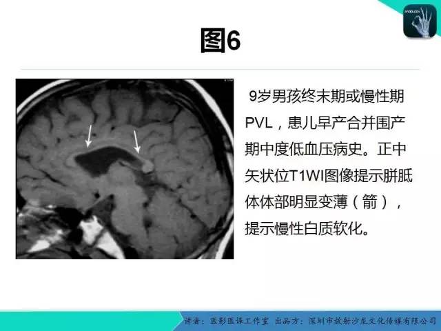 【PPT】新生儿缺氧缺血性脑病多模态影像学表现