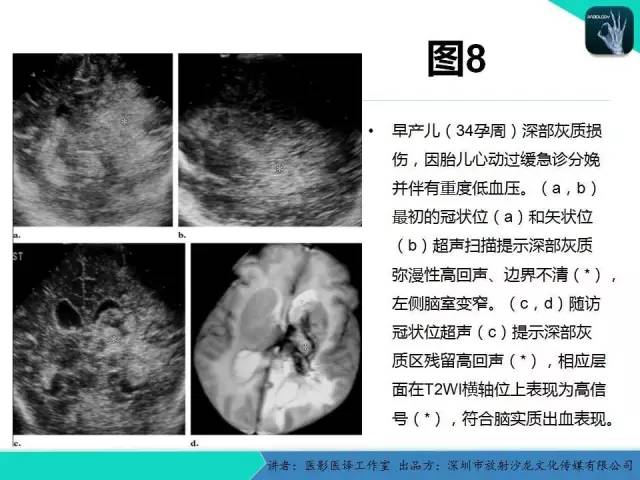 【PPT】新生儿缺氧缺血性脑病多模态影像学表现