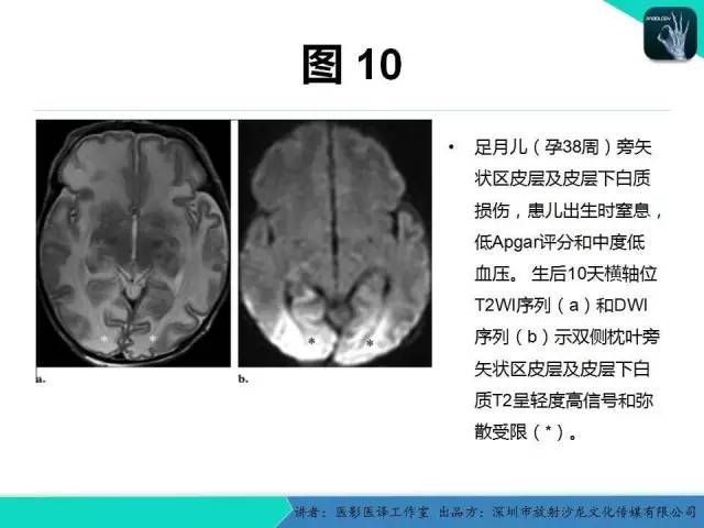 【PPT】新生儿缺氧缺血性脑病多模态影像学表现