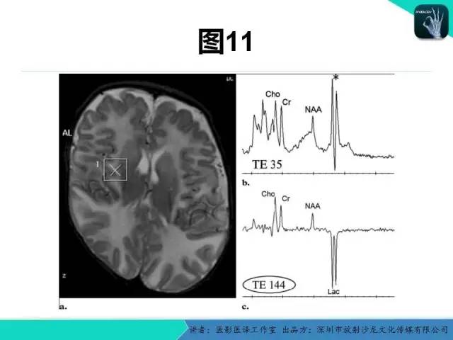 【PPT】新生儿缺氧缺血性脑病多模态影像学表现