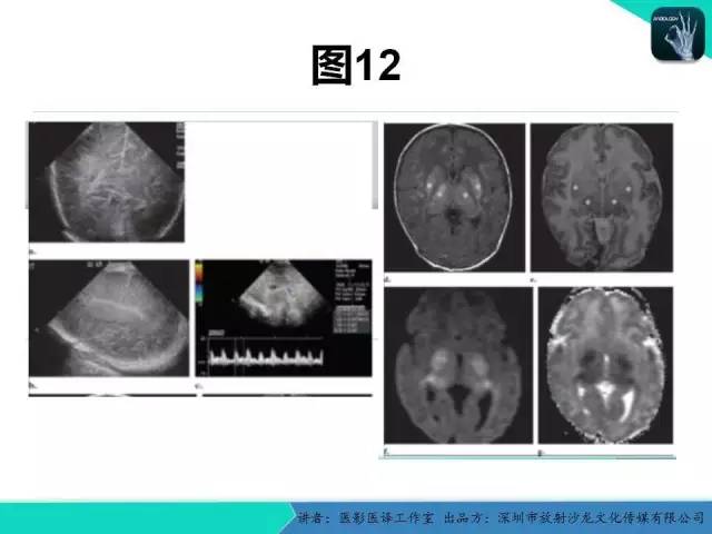 【PPT】新生儿缺氧缺血性脑病多模态影像学表现