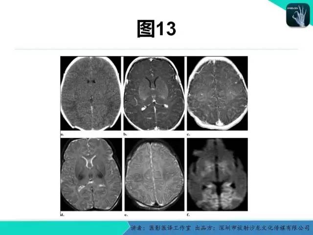 【PPT】新生儿缺氧缺血性脑病多模态影像学表现