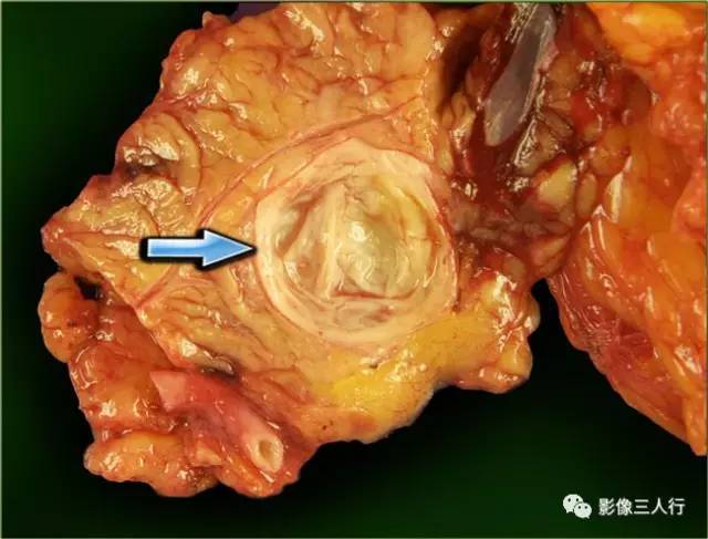 “胰腺浆液性囊性肿瘤 ”的影像诊断