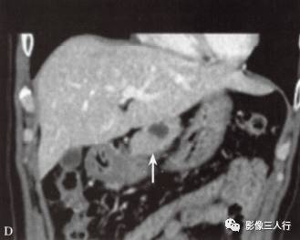 “胰腺浆液性囊性肿瘤 ”的影像诊断