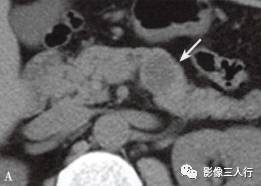 “胰腺浆液性囊性肿瘤 ”的影像诊断