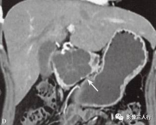 “胰腺浆液性囊性肿瘤 ”的影像诊断
