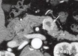 “胰腺浆液性囊性肿瘤 ”的影像诊断