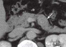 “胰腺浆液性囊性肿瘤 ”的影像诊断