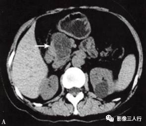“胰腺浆液性囊性肿瘤 ”的影像诊断