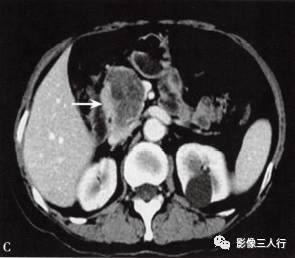 “胰腺浆液性囊性肿瘤 ”的影像诊断