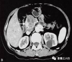 “胰腺浆液性囊性肿瘤 ”的影像诊断