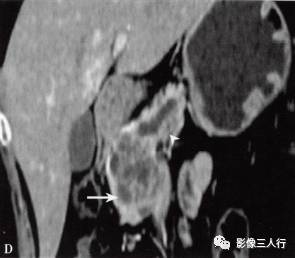 “胰腺浆液性囊性肿瘤 ”的影像诊断
