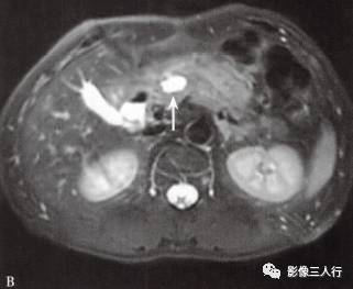 “胰腺浆液性囊性肿瘤 ”的影像诊断