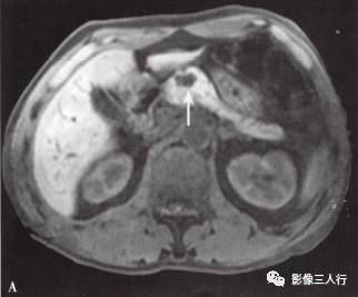 “胰腺浆液性囊性肿瘤 ”的影像诊断