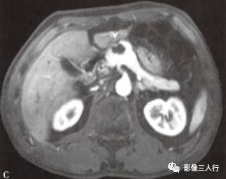 “胰腺浆液性囊性肿瘤 ”的影像诊断