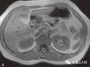 “胰腺浆液性囊性肿瘤 ”的影像诊断