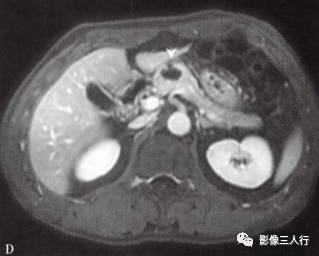 “胰腺浆液性囊性肿瘤 ”的影像诊断