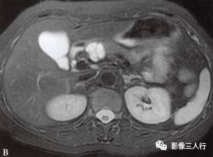 “胰腺浆液性囊性肿瘤 ”的影像诊断