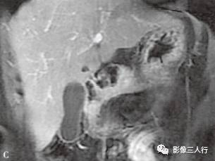 “胰腺浆液性囊性肿瘤 ”的影像诊断