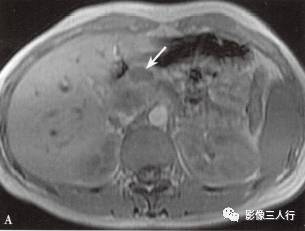 “胰腺浆液性囊性肿瘤 ”的影像诊断