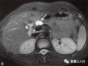 “胰腺浆液性囊性肿瘤 ”的影像诊断
