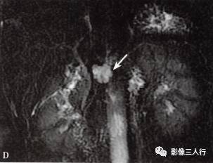 “胰腺浆液性囊性肿瘤 ”的影像诊断