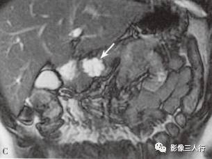 “胰腺浆液性囊性肿瘤 ”的影像诊断
