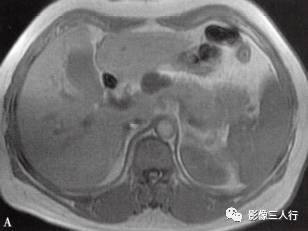 “胰腺浆液性囊性肿瘤 ”的影像诊断