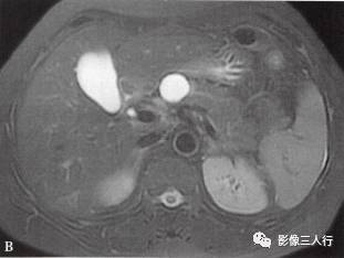 “胰腺浆液性囊性肿瘤 ”的影像诊断