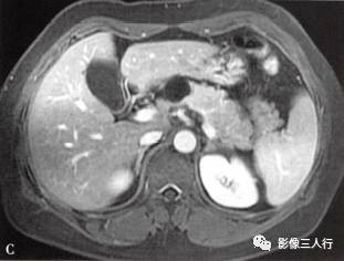 “胰腺浆液性囊性肿瘤 ”的影像诊断