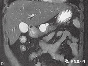 “胰腺浆液性囊性肿瘤 ”的影像诊断