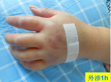 碘对比剂外渗后啥样？有图有真相