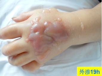 碘对比剂外渗后啥样？有图有真相
