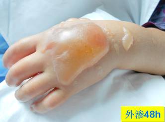 碘对比剂外渗后啥样？有图有真相