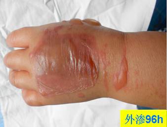 碘对比剂外渗后啥样？有图有真相