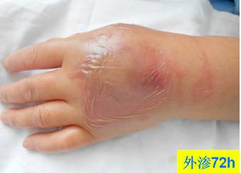 碘对比剂外渗后啥样？有图有真相