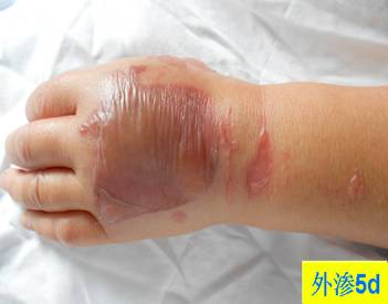 碘对比剂外渗后啥样？有图有真相