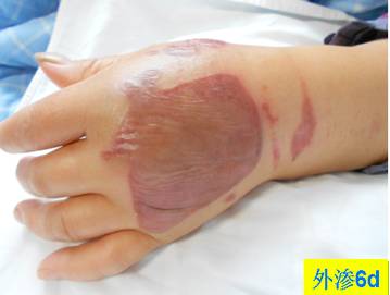 碘对比剂外渗后啥样？有图有真相