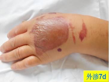 碘对比剂外渗后啥样？有图有真相