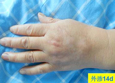 碘对比剂外渗后啥样？有图有真相