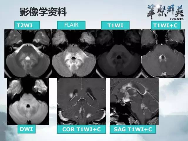 【病例】Clippers综合征1例MR影像表现