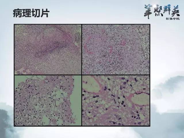【病例】Clippers综合征1例MR影像表现