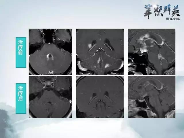 【病例】Clippers综合征1例MR影像表现