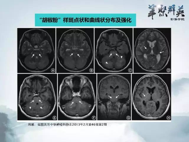 【病例】Clippers综合征1例MR影像表现
