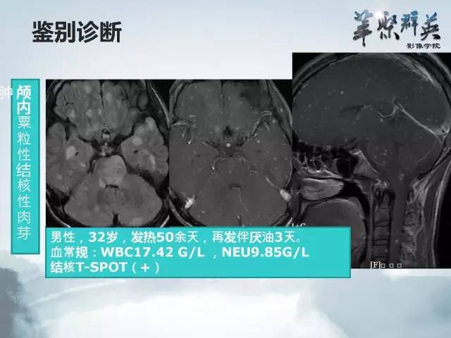 【病例】Clippers综合征1例MR影像表现