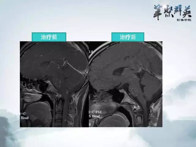 【病例】Clippers综合征1例MR影像表现