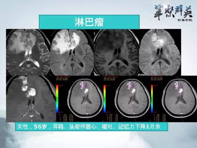 【病例】Clippers综合征1例MR影像表现