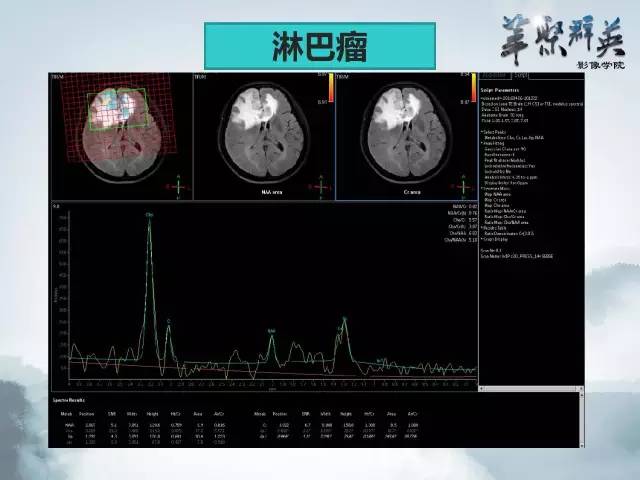 【病例】Clippers综合征1例MR影像表现