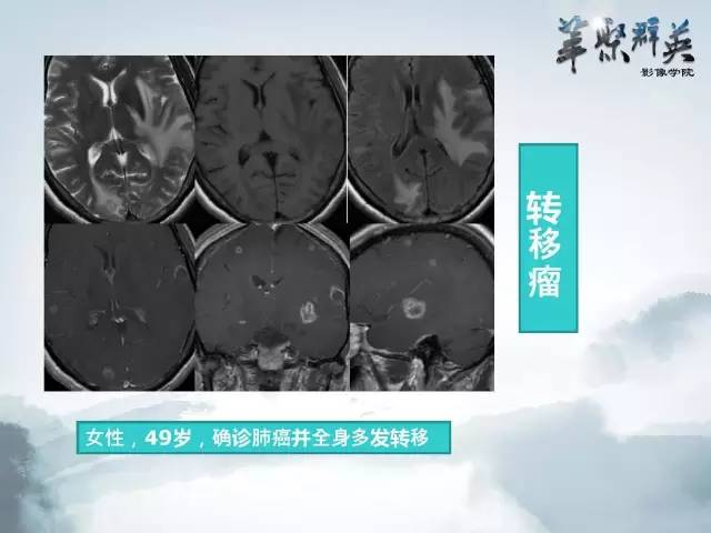 【病例】Clippers综合征1例MR影像表现